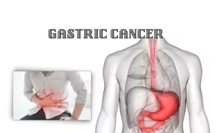 Treatments Of Gastric Cancer By CancerSurgeryClinic