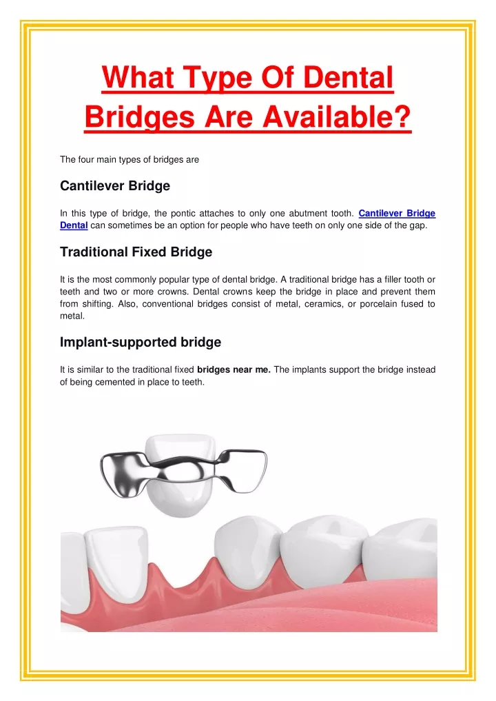 what type of dental bridges are available