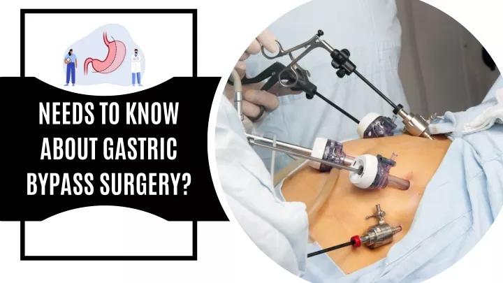 needs to know about gastric bypass surgery