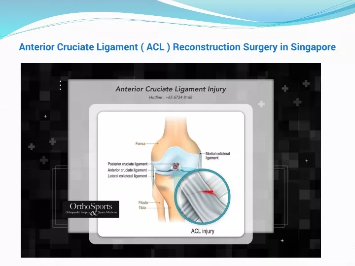 anterior cruciate ligament acl reconstruction