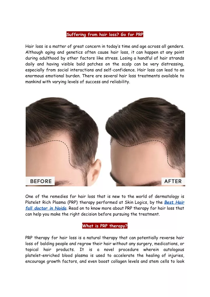 suffering from hair loss go for prp