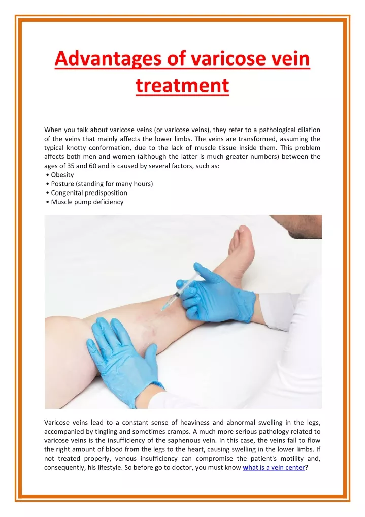 advantages of varicose vein treatment when