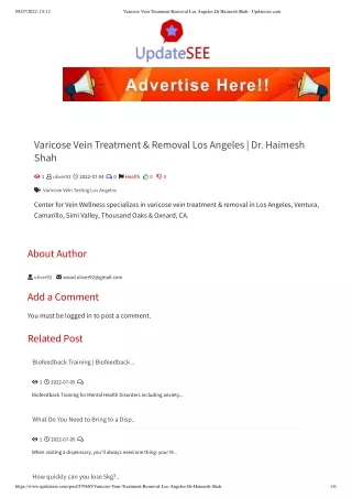 Varicose Vein Treatment Removal Los Angeles Dr Haimesh Shah - Updatesee.com