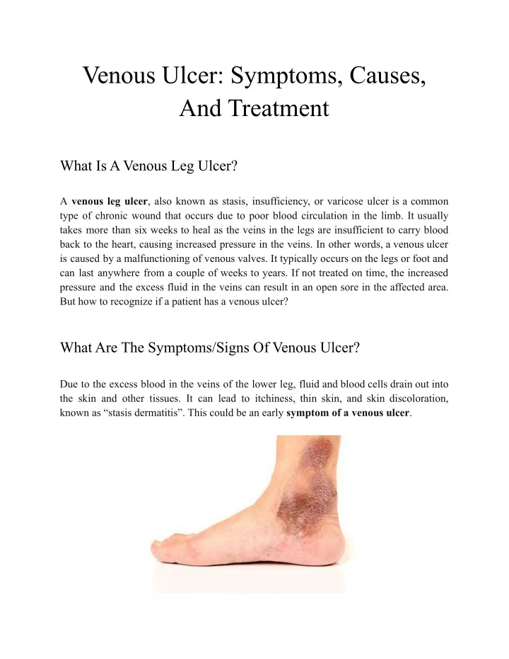 venous ulcer symptoms causes and treatment