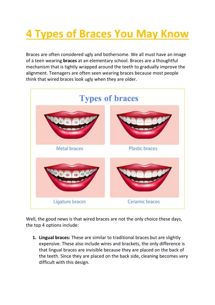 4 types of braces you may know