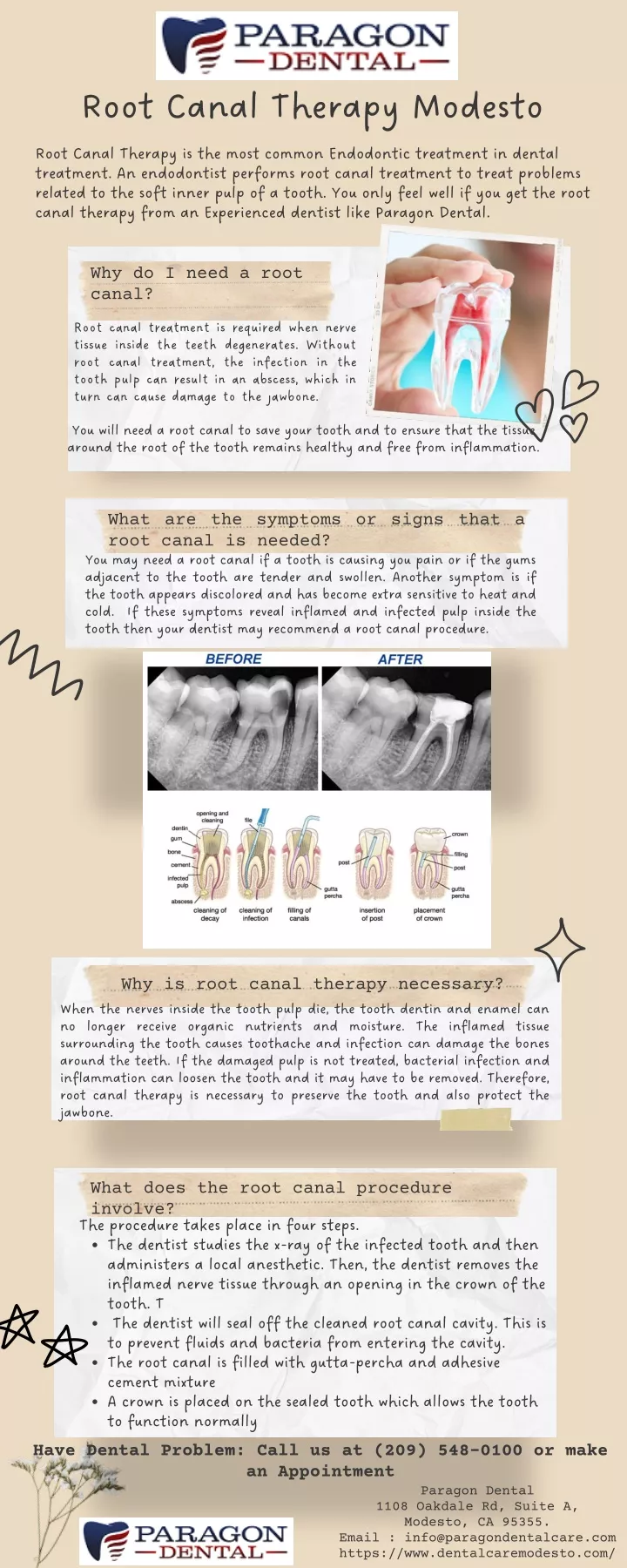 root canal therapy modesto treatment