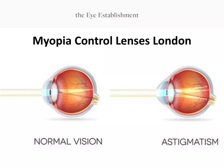 myopia control lenses london