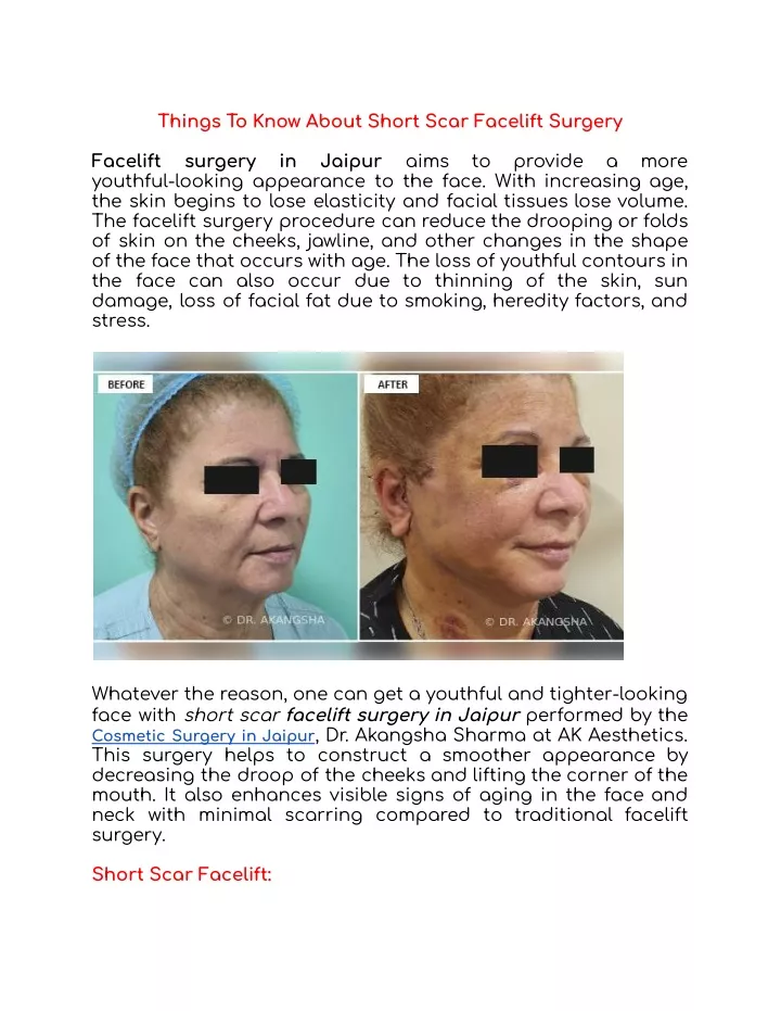 things to know about short scar facelift surgery