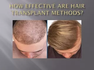 How effective are hair transplant methods