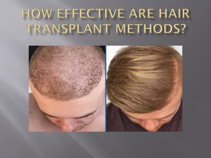 how effective are hair transplant methods