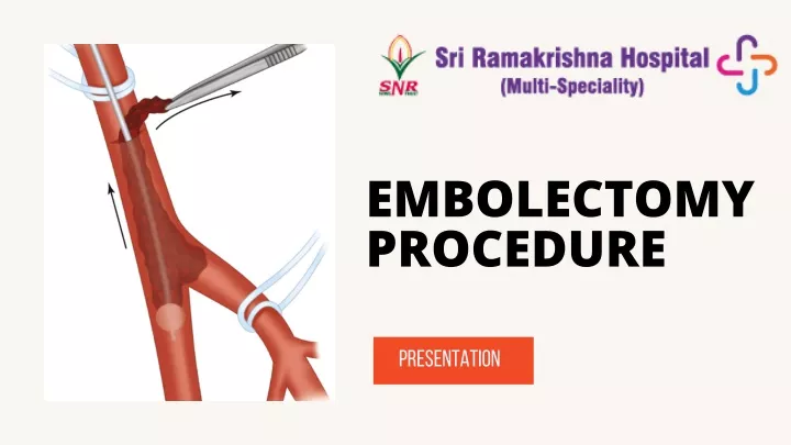 embolectomy procedure