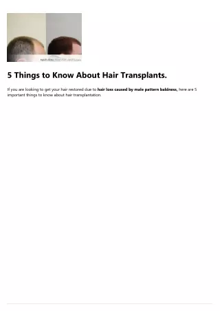 5 things to know about hair transplants