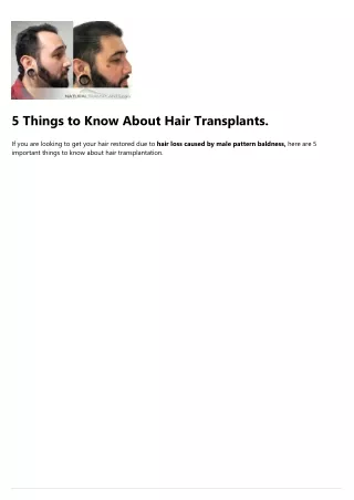 5 things to know about hair transplants