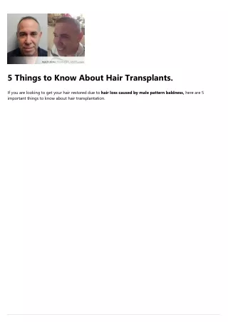5 things to know about hair transplants