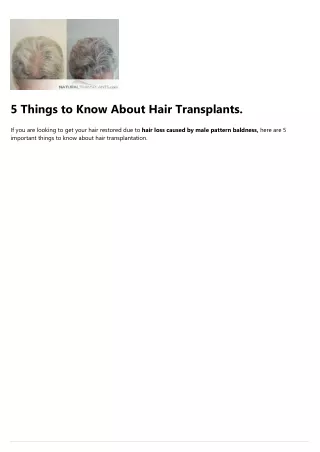 5 things to know about hair transplants