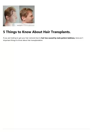 5 things to know about hair transplants