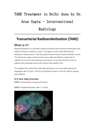 TARE Treatment in Delhi done by Dr. Arun Gupta - Interventional Radiology