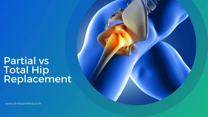 partial vs total hip replacement