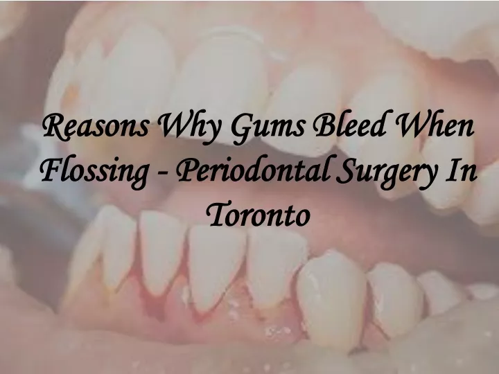 reasons why gums bleed when flossing periodontal surgery in toronto