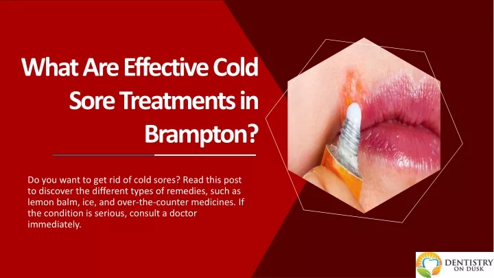 what are effective cold sore treatments