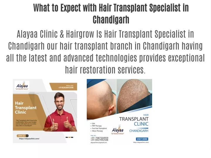 what to expect with hair transplant specialist