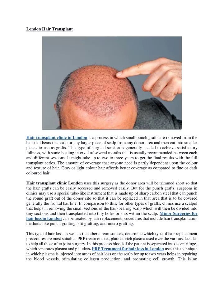 london hair transplant