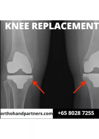 Knee Replacement - 1