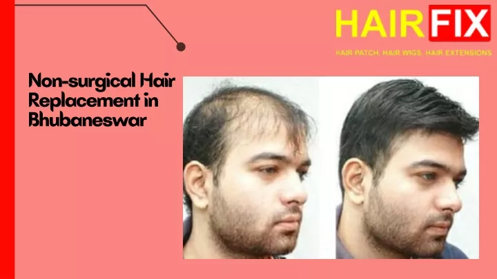 non surgical hair replacement in bhubaneswar