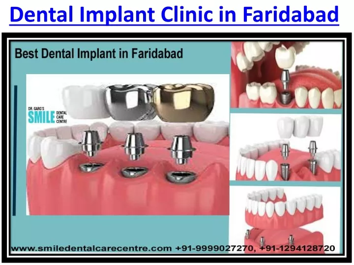 dental implant clinic in faridabad