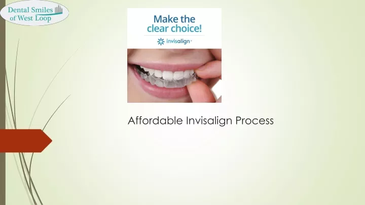 affordable invisalign process