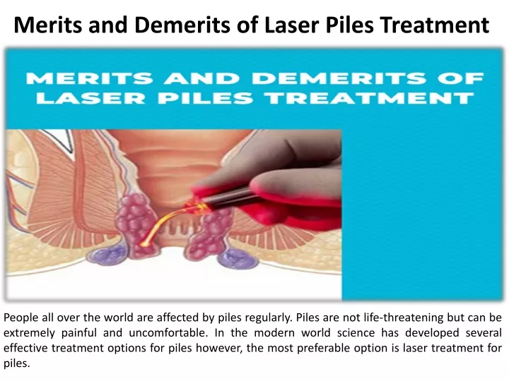 merits and demerits of laser piles treatment