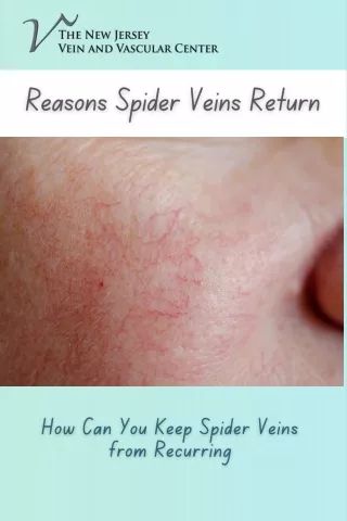 How Can You Keep Spider Veins from Recurring