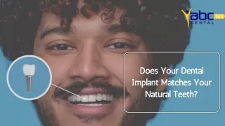 Does Your Dental Implant Matches Your Natural Teeth