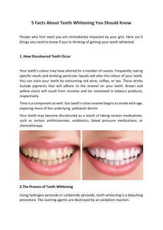 5 Facts About Teeth Whitening You Should Know