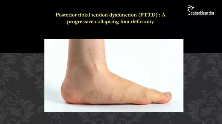 posterior tibial tendon dysfunction pttd a progressive collapsing foot deformity