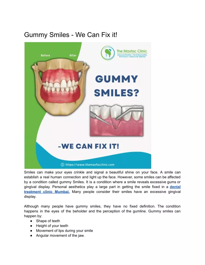 gummy smiles we can fix it