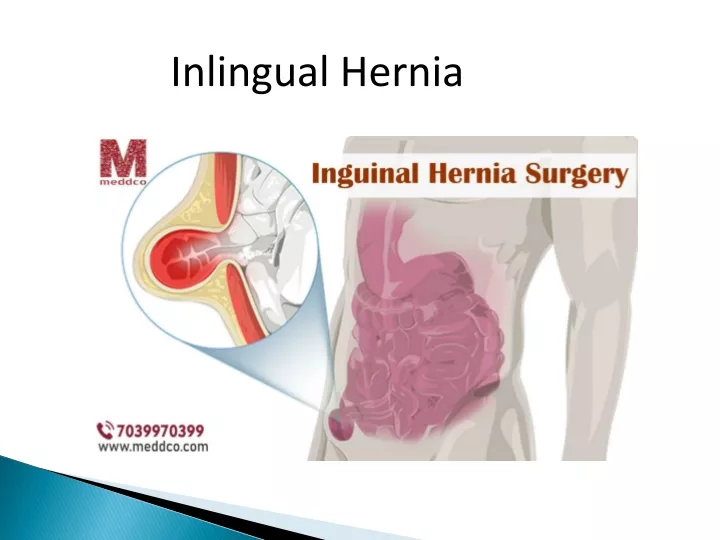 inlingual hernia