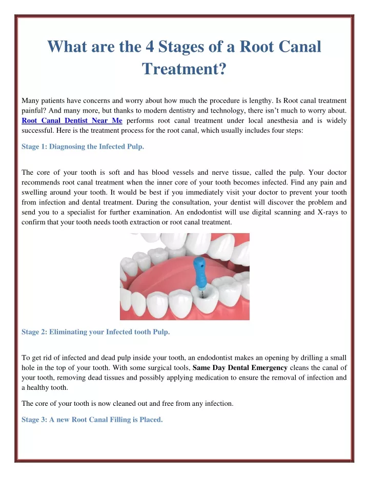 what are the 4 stages of a root canal treatment