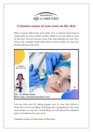 Acne Scar Treatment in Vaishali | Anugraha