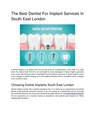 The Best Dentist For Implant Services In South East London