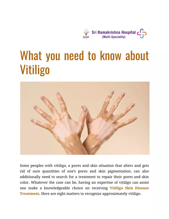 what you need to know about vitiligo