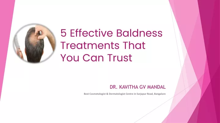 5 effective baldness treatments that you can trust