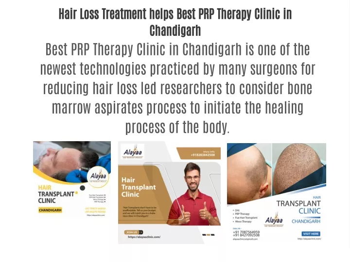 hair loss treatment helps best prp therapy clinic