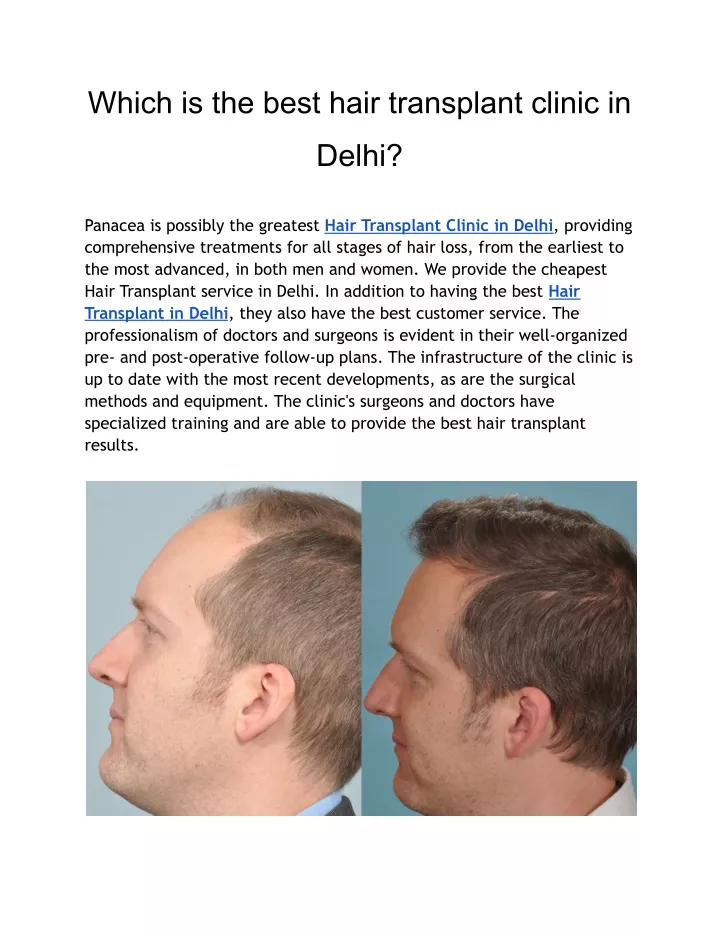 which is the best hair transplant clinic in