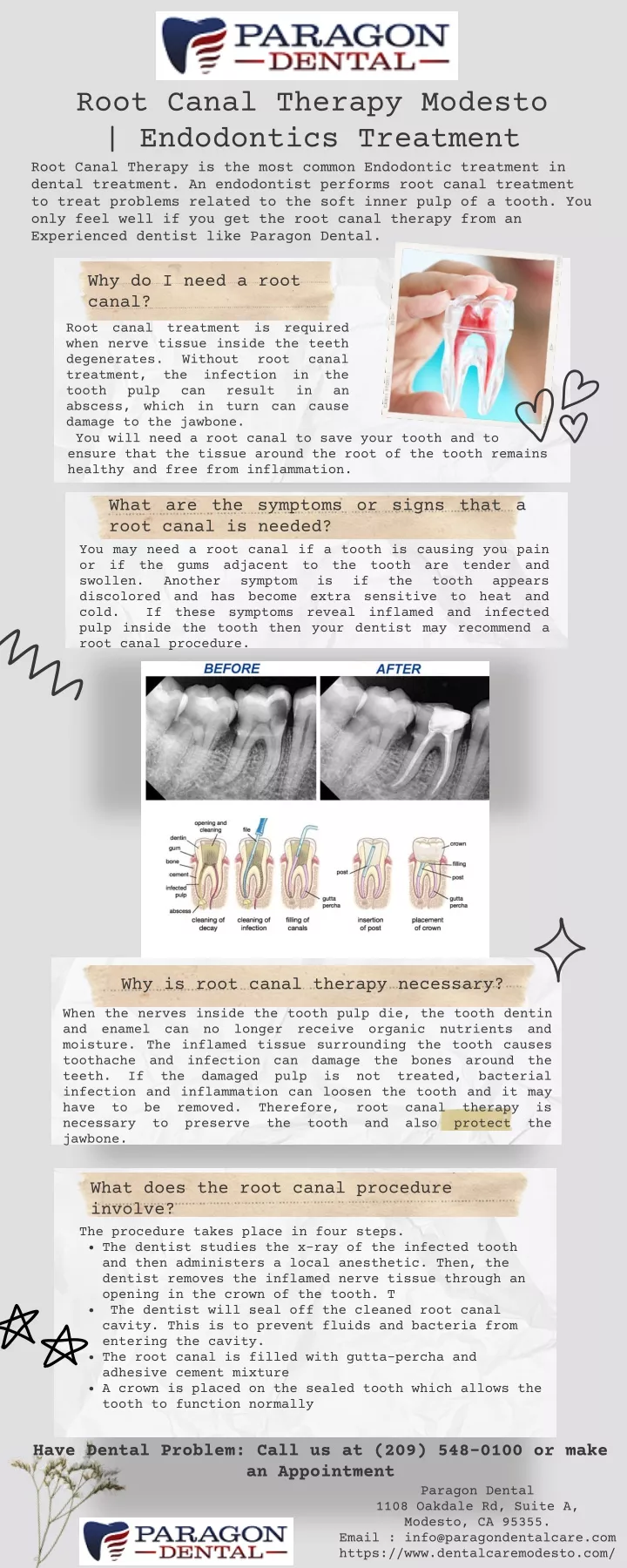 root canal therapy modesto endodontics treatment