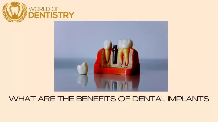 what are the benefits of dental implants