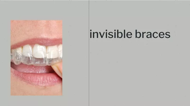 invisible braces