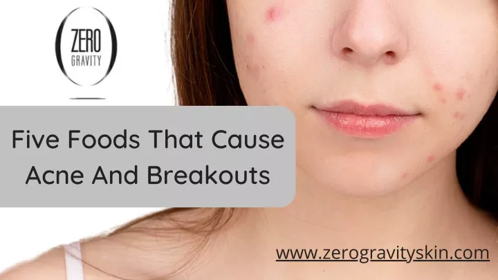 five foods that cause acne and breakouts