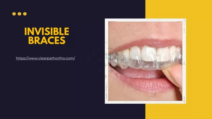 invisible braces