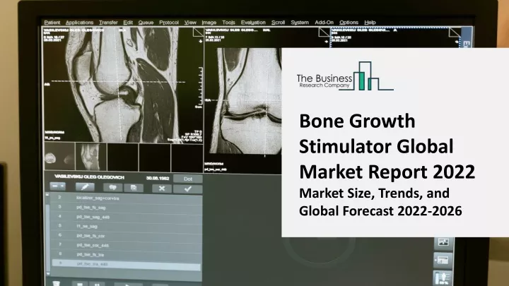 bone growth stimulator global market report 2022